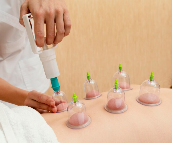 How Cupping Therapy Supports Muscle Recovery